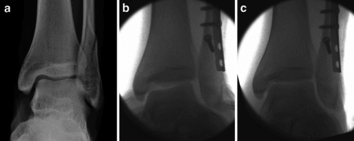 Radiographs of an SER-4 ankle fracture with a deltoid tear: spiral fibular fracture, persistent medial widening after fibular fixation, and the stable result after deltoid reconstruction.