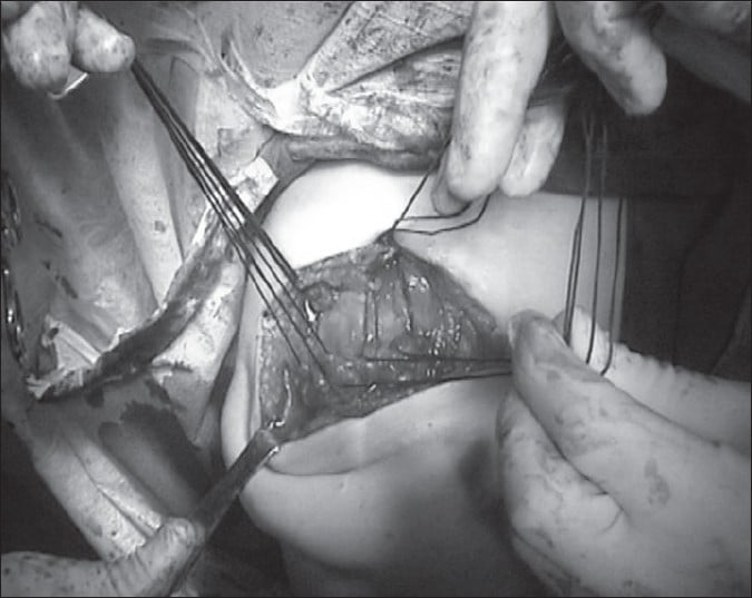 Operative view of secure proximal deltoid reattachment to the acromion