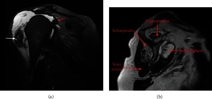 MRI showing atraumatic deltoid rupture with a chronic massive rotator cuff tear