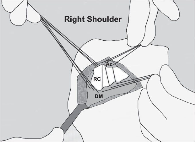 Schematic of transosseous deltoid reattachment to the acromion