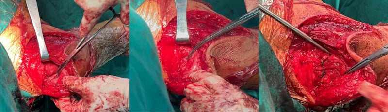 Operative sequence of middle-deltoid mobilisation and transosseous acromial repair