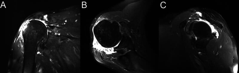 MRI showing cuff-tear arthropathy and a retracted middle-deltoid origin tear