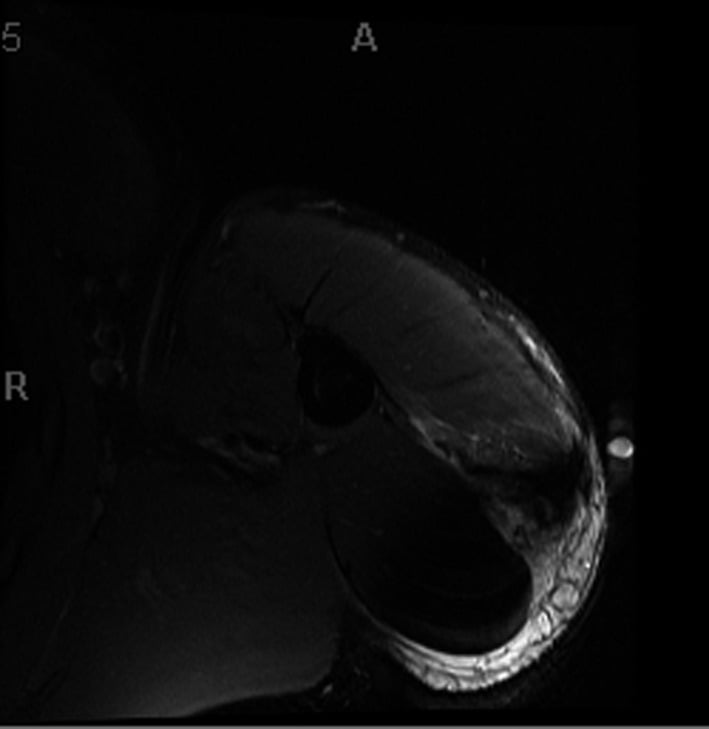 Axial STIR MRI showing posterior deltoid avulsion from the humeral insertion
