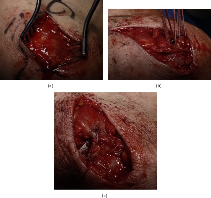 Operative sequence of proximal deltoid repair using Mason-Allen sutures and an acromial plate washer