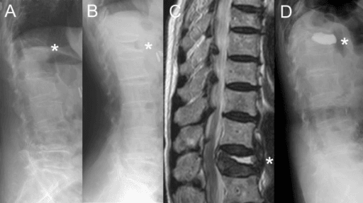 Supine lateral radiograph showing an intravertebral cleft in a severe vertebral compression fracture