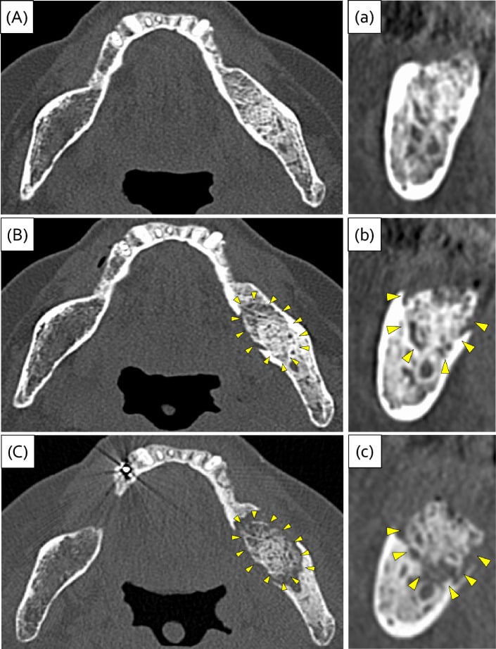 Serial CT images showing osteosclerosis and sequestration of the mandible in osteonecrosis of the jaw