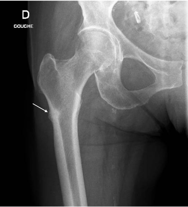 Radiograph of an atypical femoral fracture with a radiolucent line in the lateral cortex