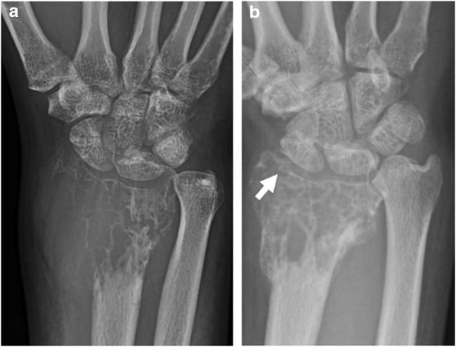 Plain radiograph of a giant cell tumour of the distal radius at presentation