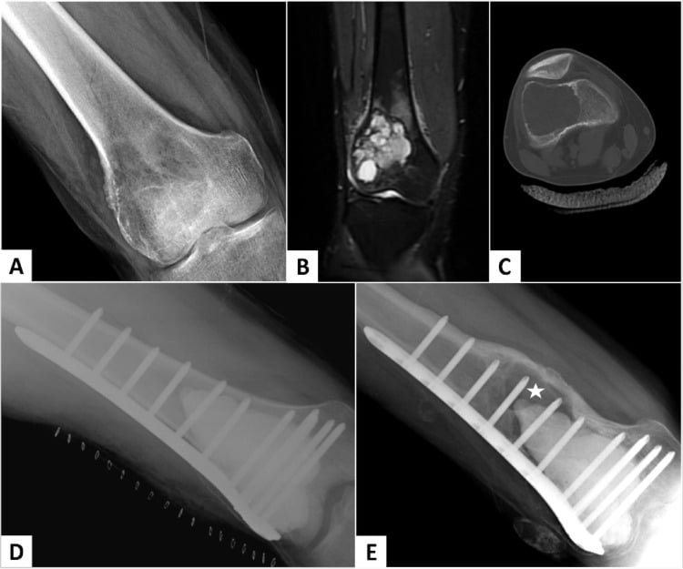 Lateral radiograph, coronal MRI and axial CT of a giant cell tumour of the distal femur