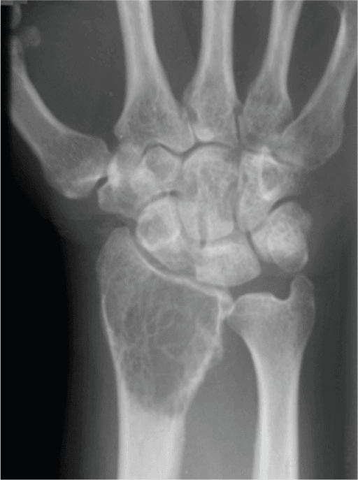 Preoperative radiograph of a giant cell tumour of the distal radius showing a classic lytic lesion