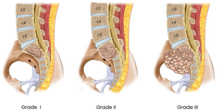 Illustration of Campanacci grades I to III of giant cell tumour of the sacrum