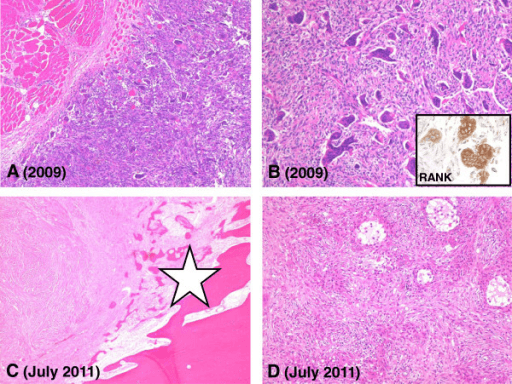 Histopathology of giant cell tumour tissue before and after denosumab treatment