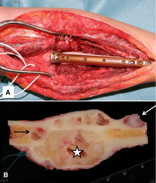 Intraoperative photograph and gross specimen of a radial resection and fibular allograft reconstruction after denosumab therapy