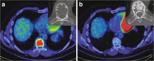 Fused axial PET-CT of a vertebral giant cell tumour at baseline and after sixteen weeks of denosumab