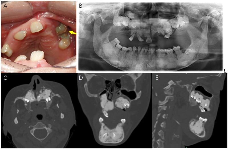 Intraoral photograph showing exposed necrotic maxillary bone in medication-related osteonecrosis of the jaw