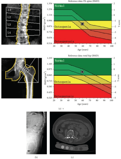 DXA bone densitometry report showing lumbar spine and hip bone mineral density plotted on age-matched reference charts in the osteopenia zone