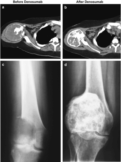 Four-panel CT and radiographs of a giant cell tumour of bone before and after denosumab showing the lytic lesion filling in with sclerotic bone