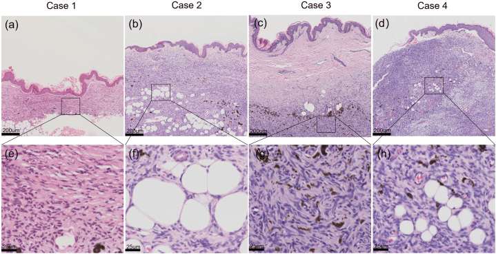 Histological spectrum of atrophic pigmented DFSP