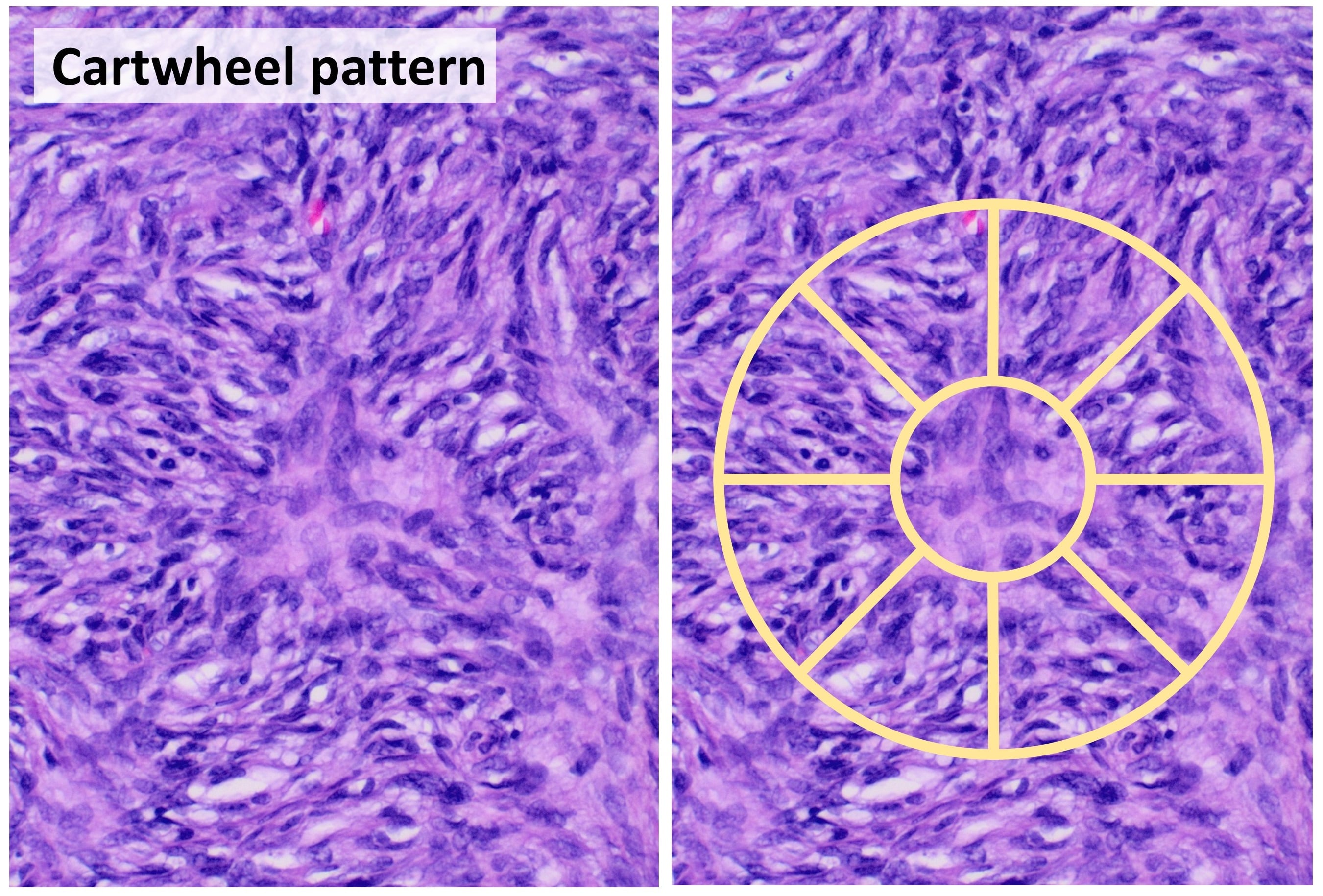 Histopathology of dermatofibrosarcoma protuberans showing the storiform (cartwheel) pattern of spindle cells, with an annotated cartwheel overlay