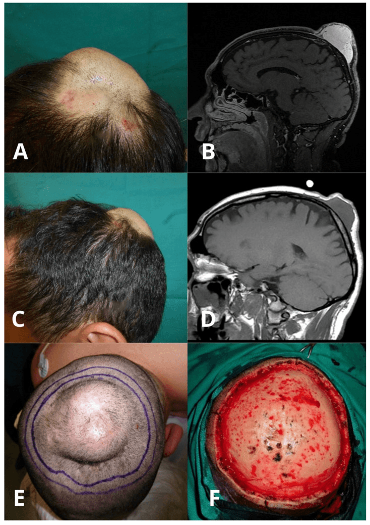 Clinical and MRI response of extensive DFSP to imatinib