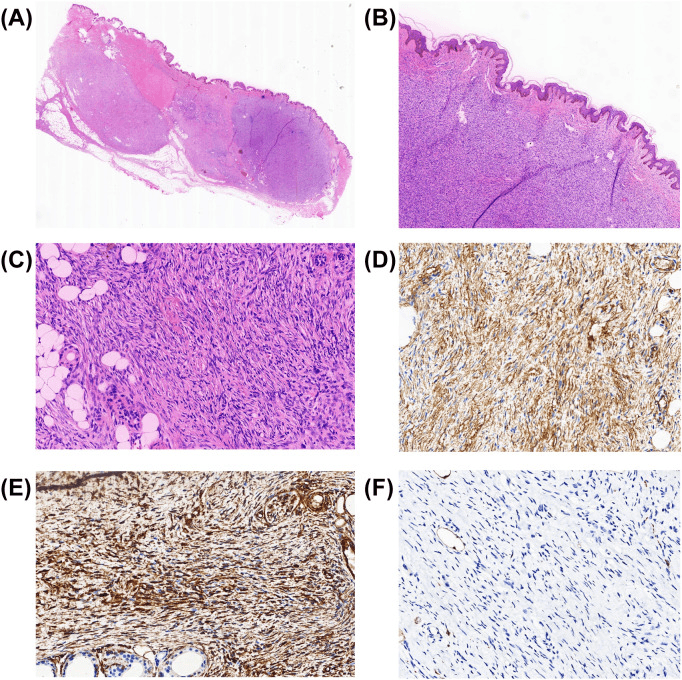 DFSP histology with CD34 immunohistochemistry