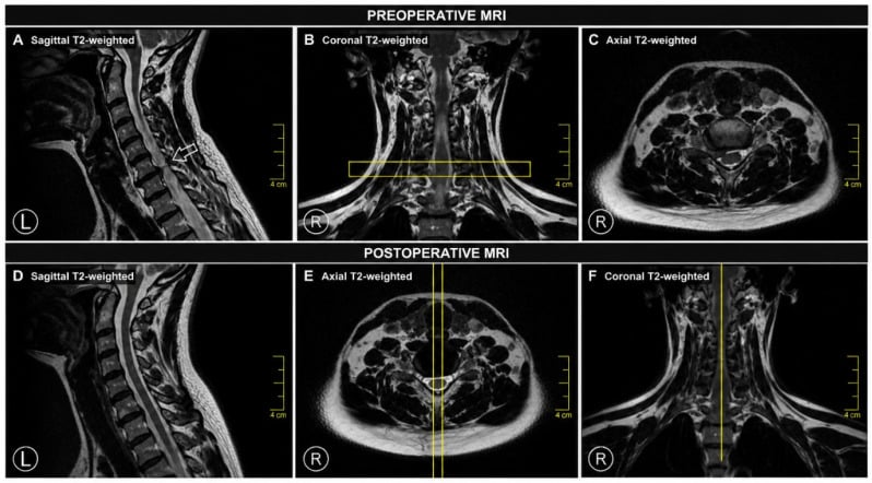 Preoperative and postoperative cervical MRI showing a lateral disc herniation compressing the exiting nerve root.