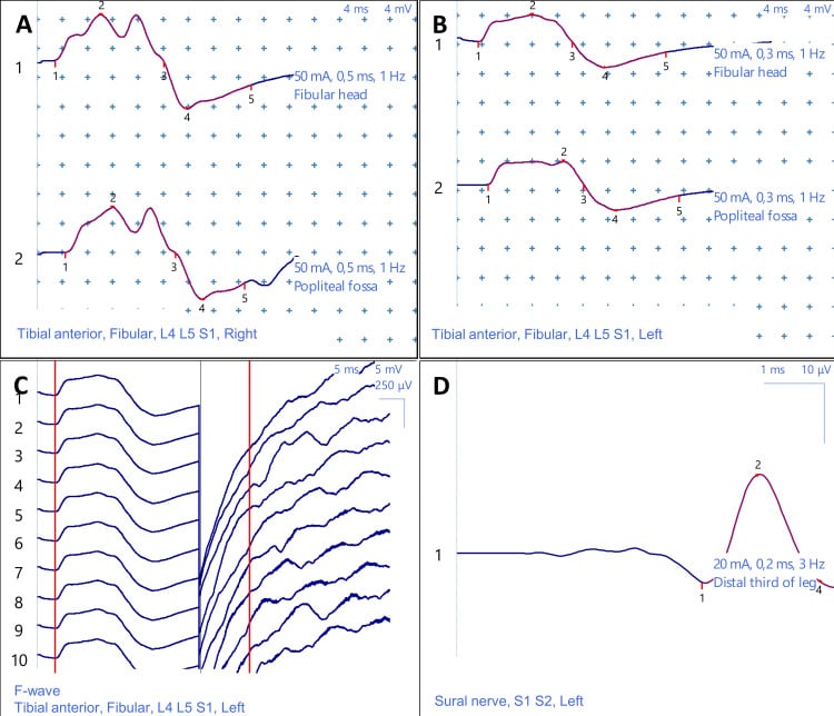 Motor and sensory nerve-conduction traces with needle EMG findings from chronic L5 radiculopathy.