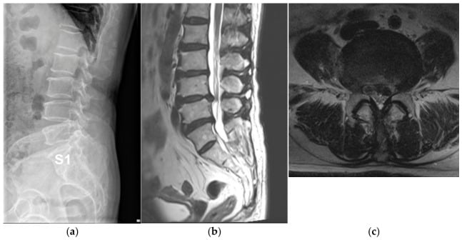 Radiograph and lumbar MRI showing transitional anatomy, L4β5 disc herniation and left L5 root compression.