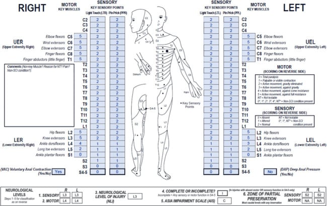 Completed ISNCSCI worksheet illustrating classification of a motor-incomplete spinal cord injury.