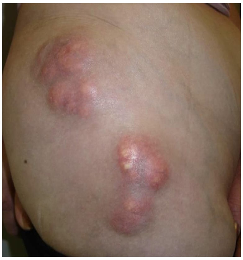 Calcinosis cutis - firm, violaceous subcutaneous nodules containing calcium deposits