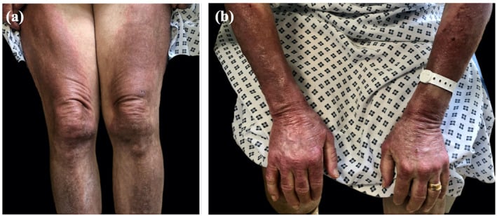 Clinical photograph demonstrating Gottron's sign over the knees and hands in dermatomyositis
