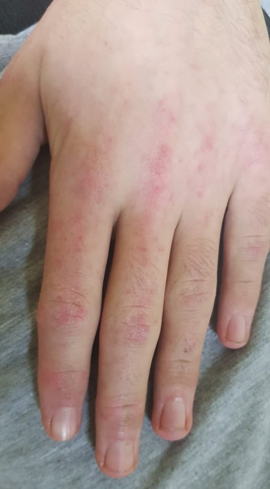 Clinical photograph demonstrating Gottron's papules over the dorsal MCP and PIP joints