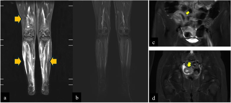 Coronal T2 STIR MRI of lower limbs demonstrating calf and thigh muscle edema