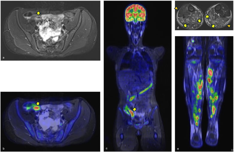 Whole-body PET/MR fusion scan demonstrating increased FDG uptake in active myositis