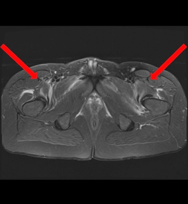 Axial STIR MRI of the pelvis demonstrating adductor and gluteal muscle edema