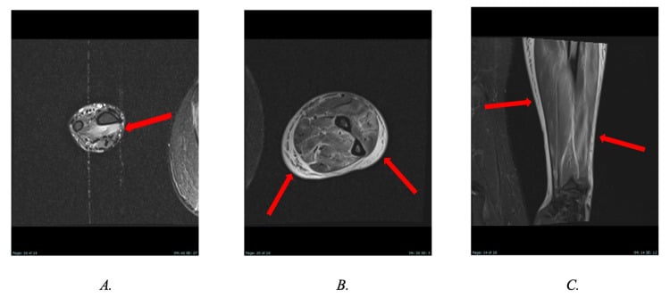 Axial and coronal STIR MRI of the forearm demonstrating muscle edema and fascial inflammation