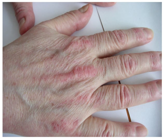 Gottron's papules - violaceous, slightly raised papules over the knuckles in dermatomyositis