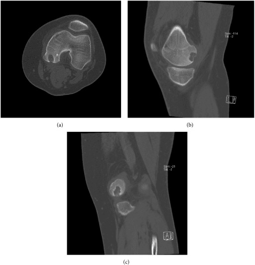 Axial, sagittal and coronal CT images showing a well-defined lytic lesion in the medial femoral condyle
