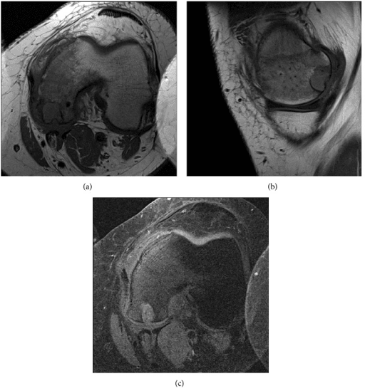 Axial and sagittal MRI showing a well-defined medial femoral condyle lesion abutting the articular surface