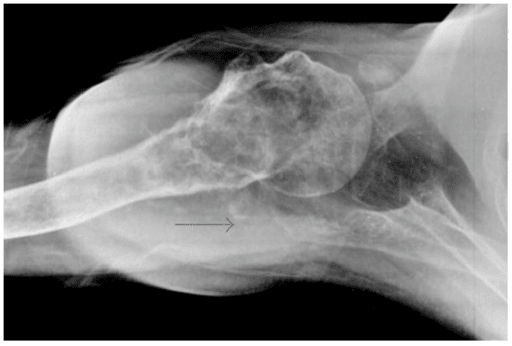 Axial shoulder radiograph showing soft tissue swelling with small flecks of calcification marked by an arrow.