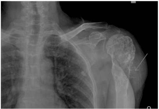AP radiograph of left shoulder with a lobulated expansile lucent lesion in the humeral head, neck and proximal shaft.