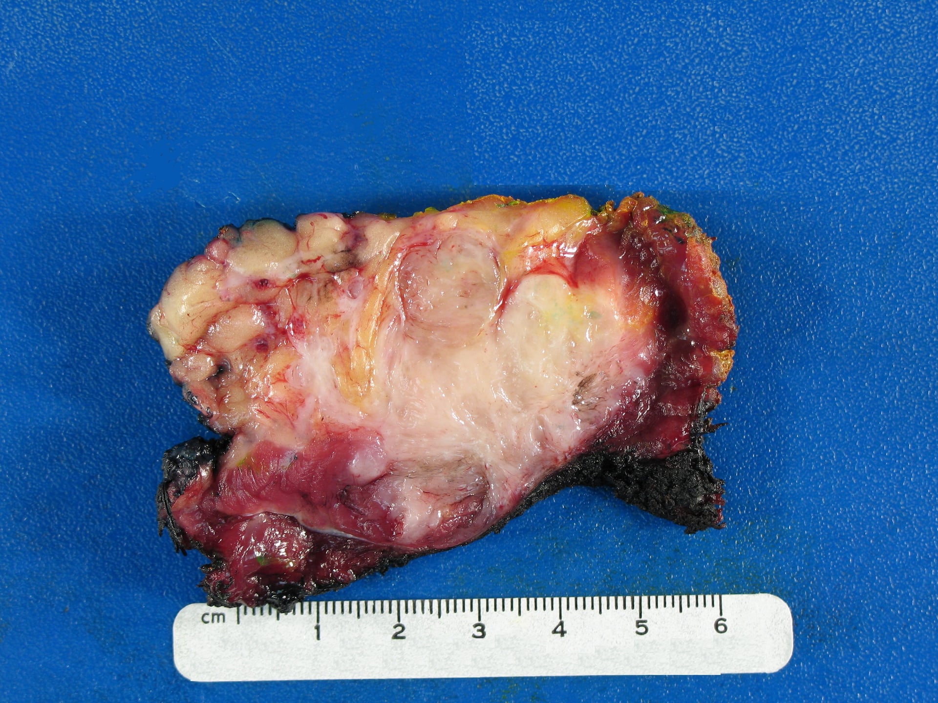 Cut surface of a resected desmoid tumour infiltrating muscle and fat.