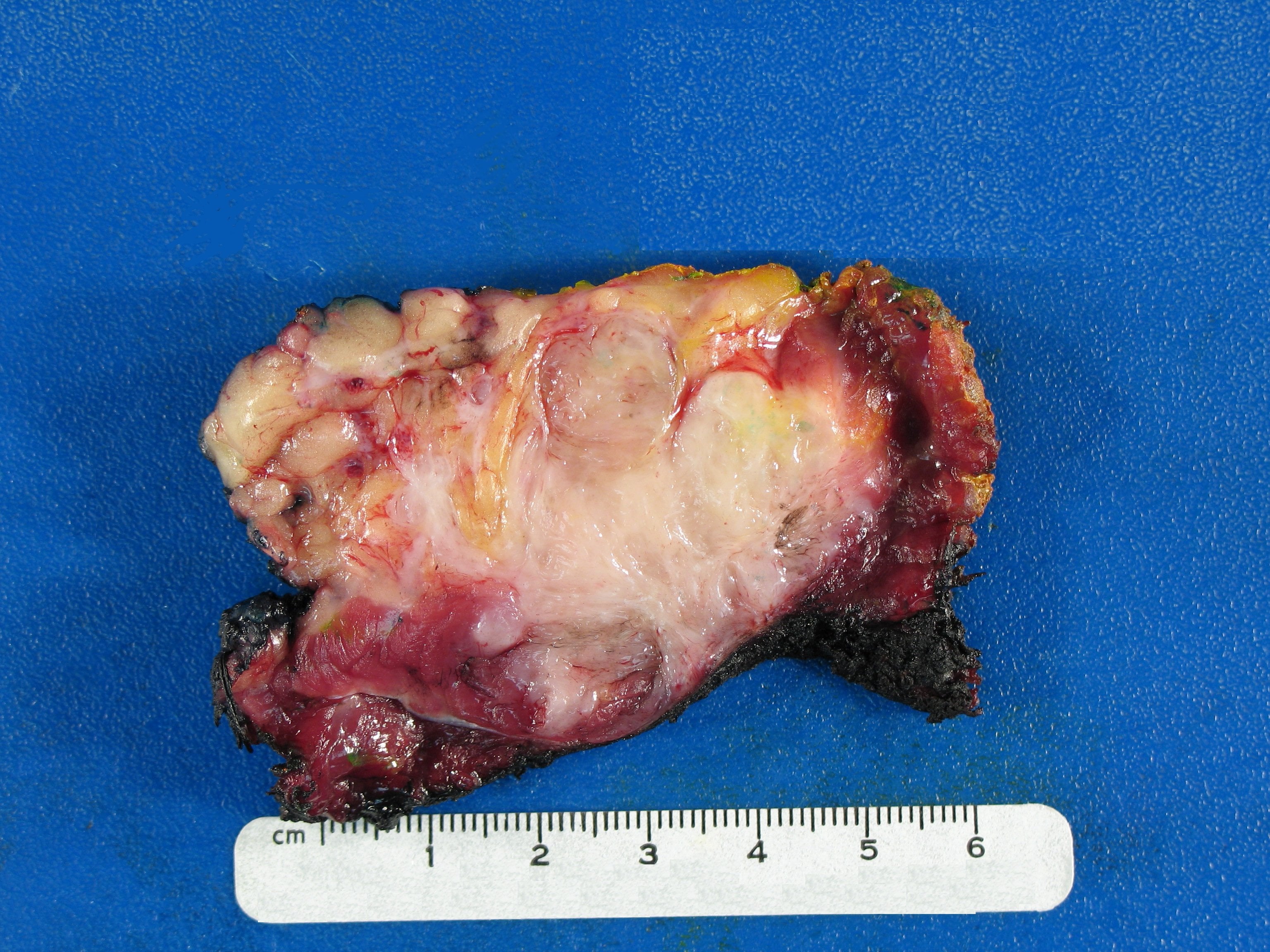 Cut surface of a resected desmoid tumour infiltrating muscle and fat.