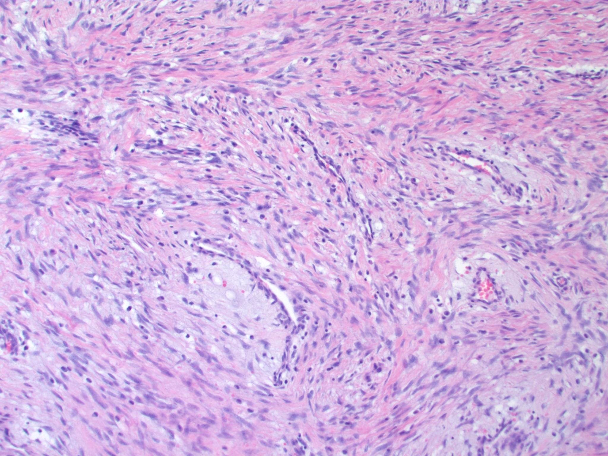 H&E histology of desmoid fibromatosis: sweeping fascicles of bland spindle cells.