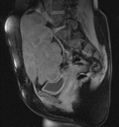 Sagittal MRI of the pelvis showing a desmoid soft-tissue mass.