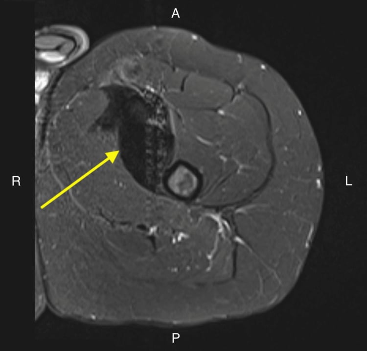 Axial STIR MRI demonstrating deep thigh muscle infiltration by a desmoid tumor