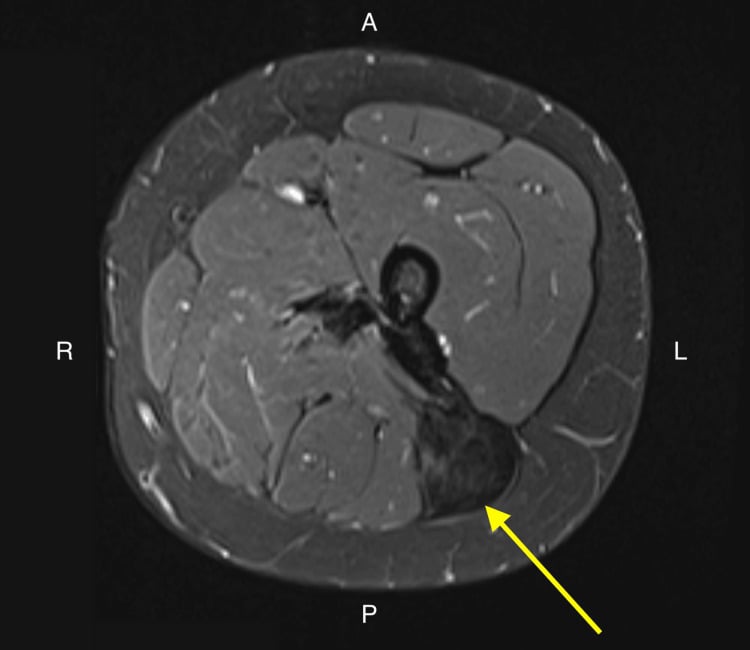 Axial STIR MRI showing the posterior compartment of a thigh desmoid tumor