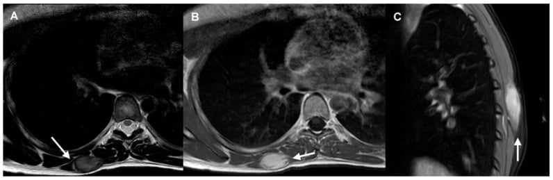 Axial T2 MRI of a desmoid tumor of the right trapezius muscle