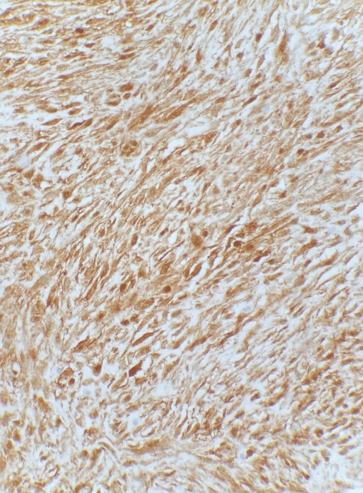 High-power immunohistochemistry micrograph showing nuclear beta-catenin accumulation in desmoid fibromatosis