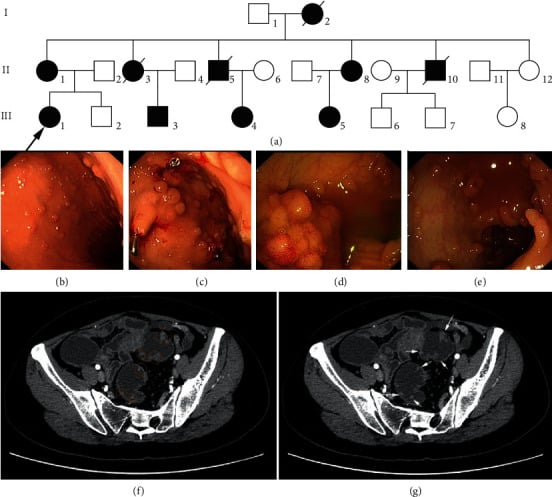 Family pedigree and clinical findings in familial adenomatous polyposis and Gardner syndrome